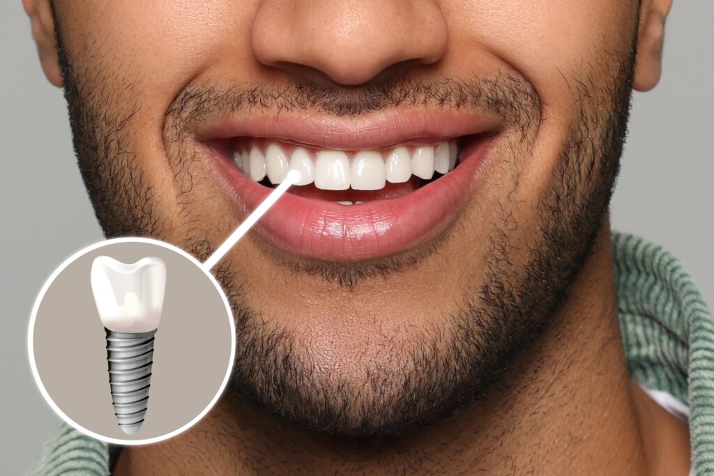The Dental Implant Journey: What You Need to Know About the Process