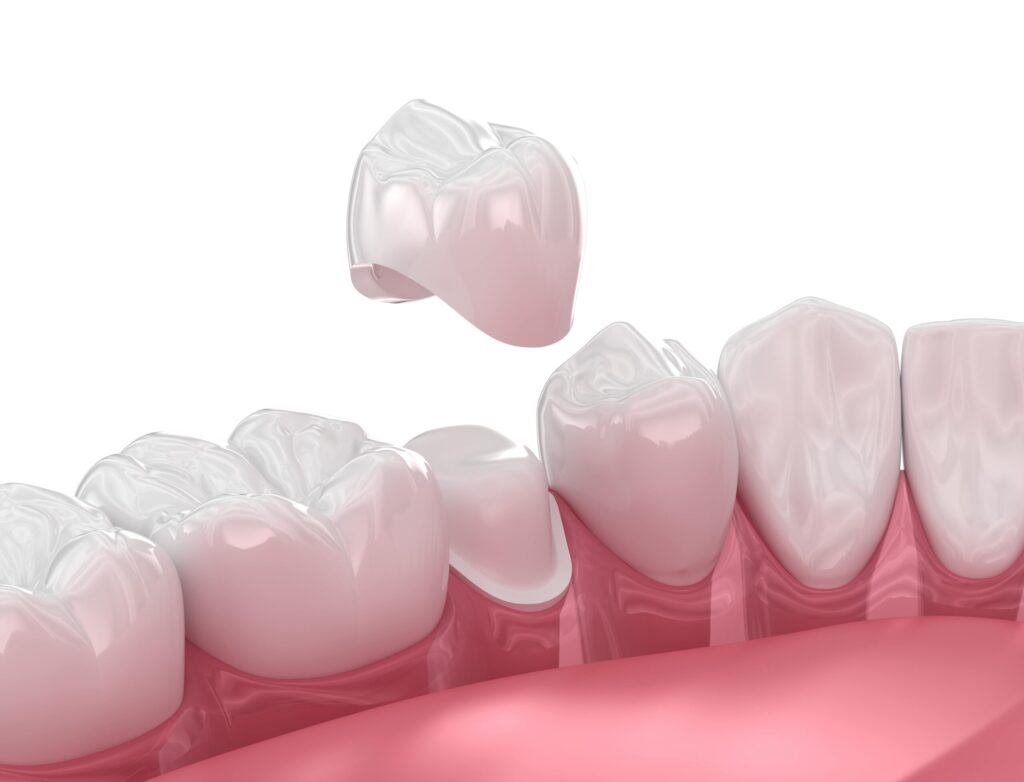 Understanding Dental Crowns A Comprehensive Guide from DeAngelis Family Dentistry in Carlsbad, CA