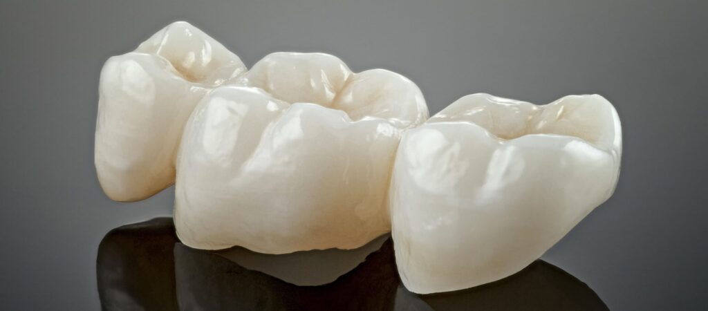 Dental Crowns: What You Need to Know