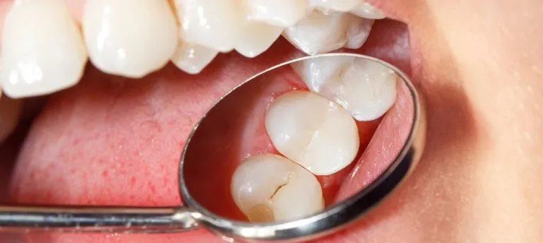 Common Endodontic Treatments Near Carlsbad