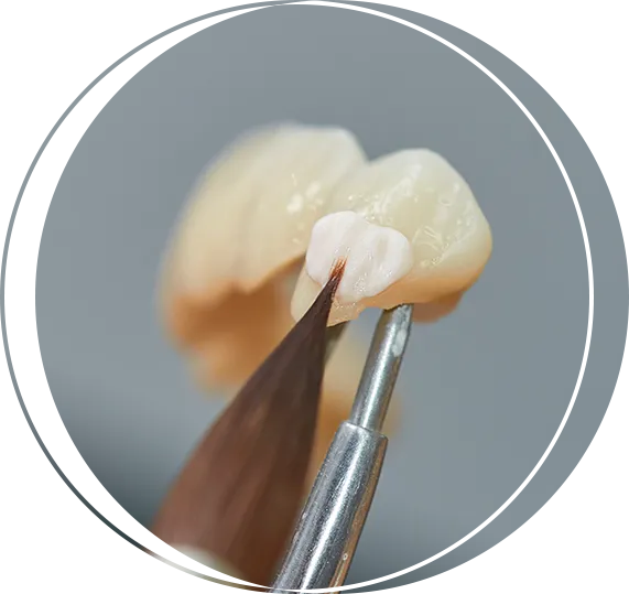 Dental Inlays & Onlays In Carlsbad, CA