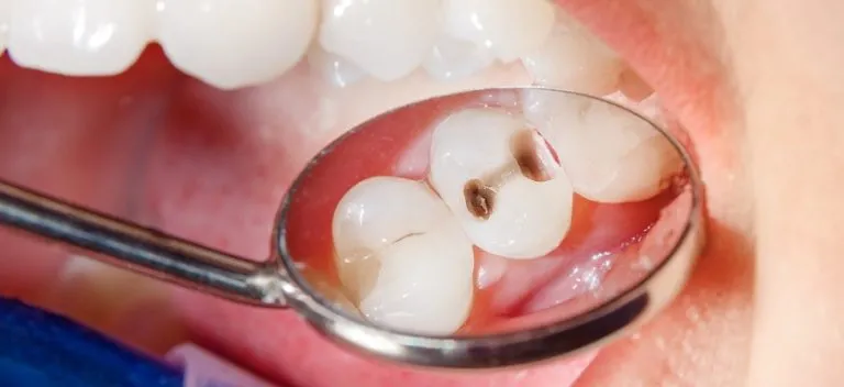 Endodontics Dentistry In Carlsbad, CA