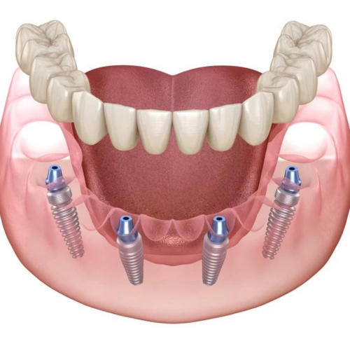 All-On-4 Dental Implants in Carlsbad, CA
