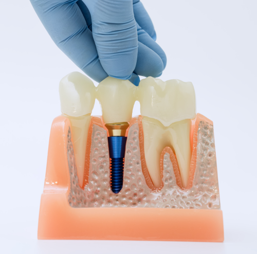 Dental Crowns