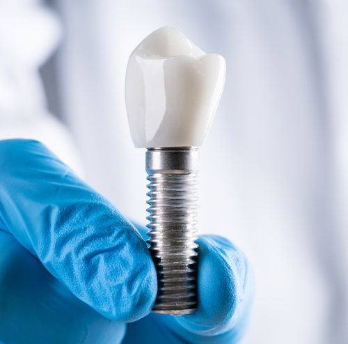 Dental Implants