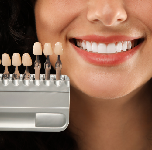 Dental Veneers by DeAngelis Family Dentistry