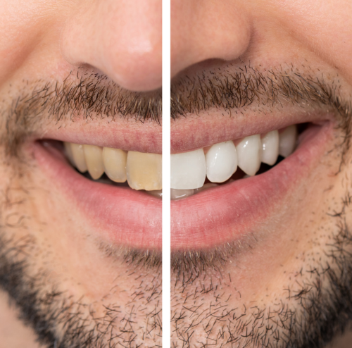 Teeth Whitening in Carlsbad, CA
