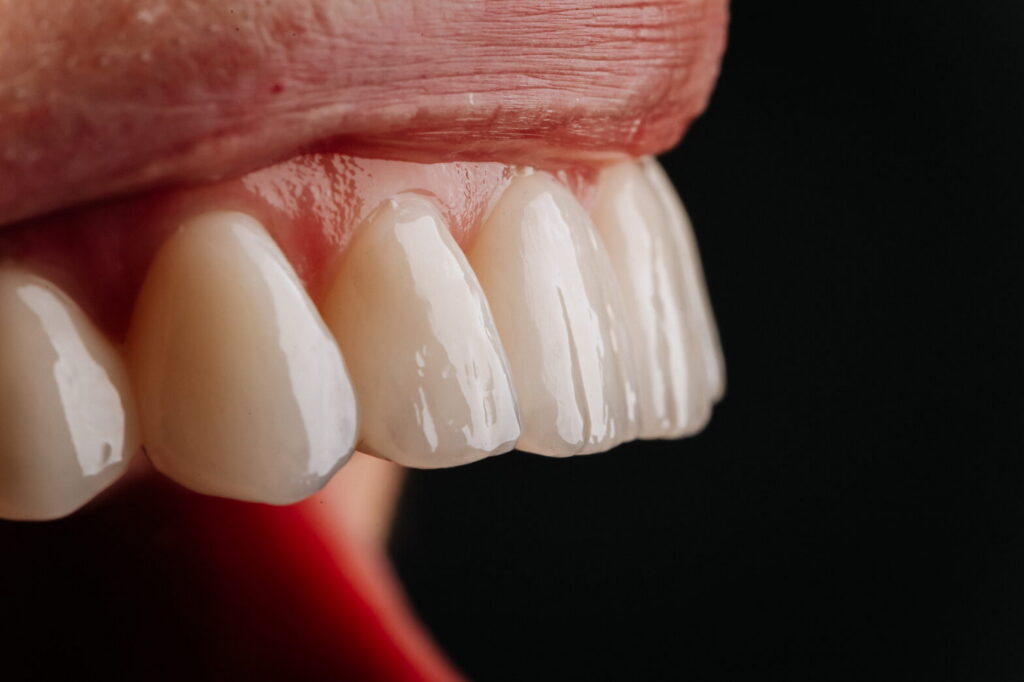7 Benefits of Getting Porcelain Veneers for a Confident Smile