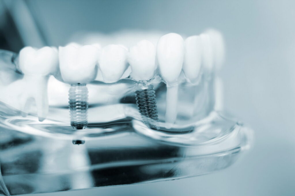 The Complete Guide to Affordable Dental Implants