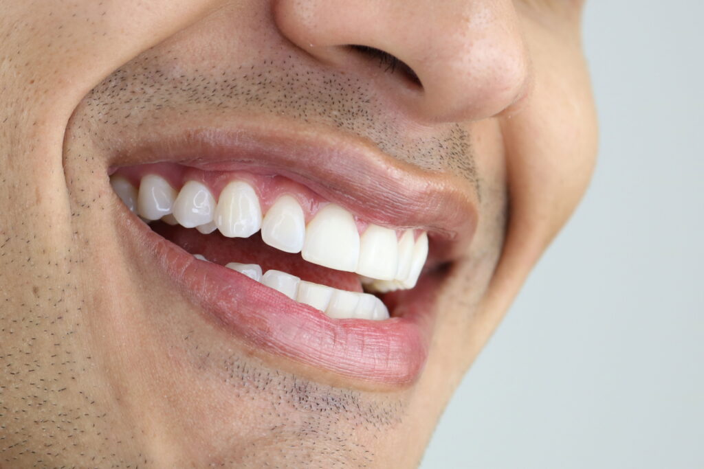 Tips for Avoiding Sensitivity After Teeth Whitening