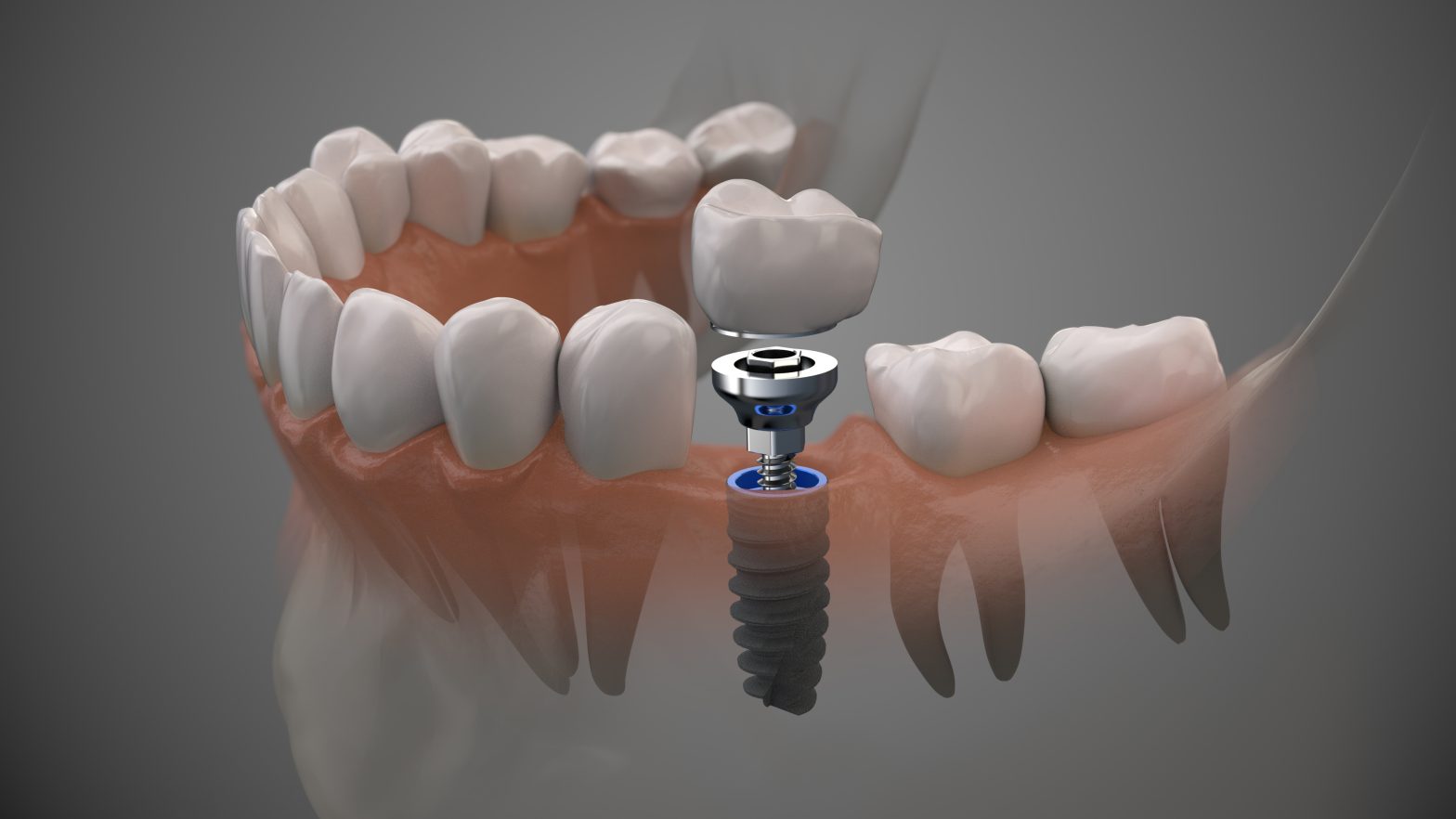 Right Dental Implant Provider