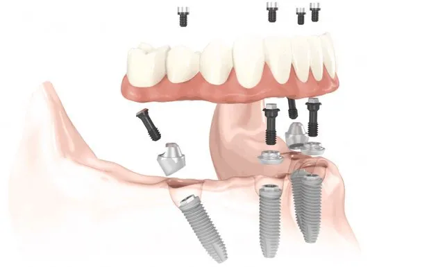 All-On-4 Dental Implants In Carlsbad