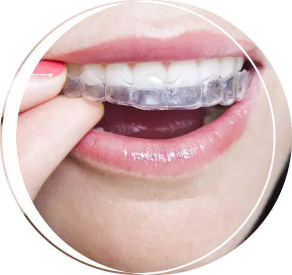 Clear Aligners In Carlsbad, CA