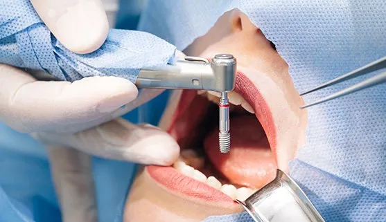 Dental Implant Restoration Procedure Near Carlsbad