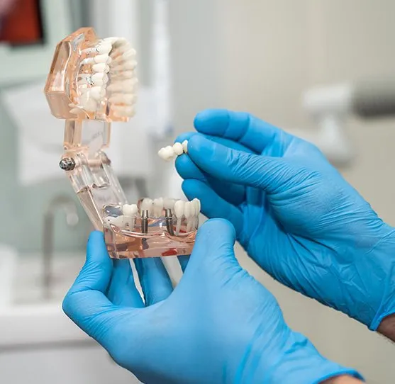 What Are All-On-4 Dental Implants?